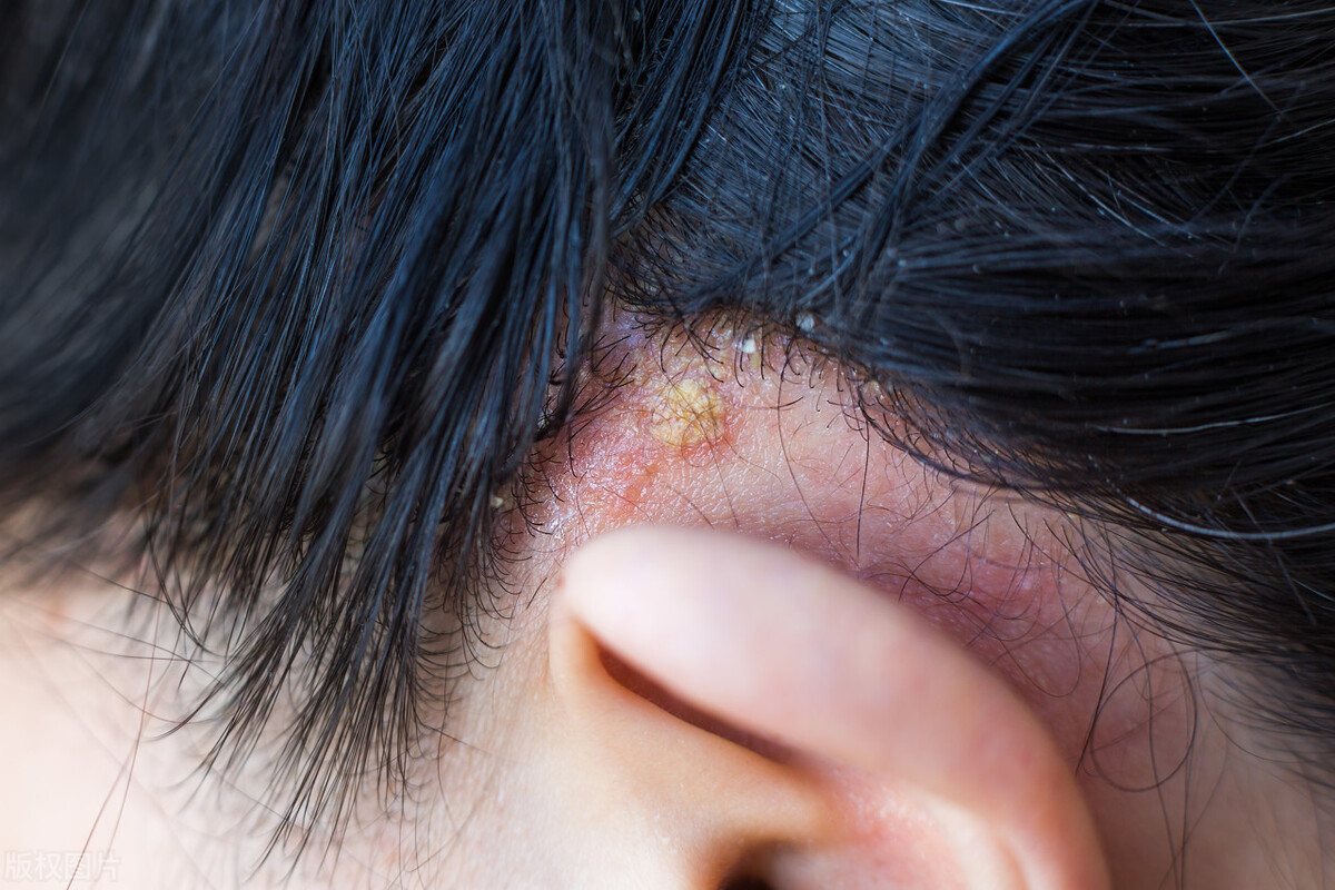 米诺地尔真的能治脱发,米诺地尔真的能够治好脱发吗