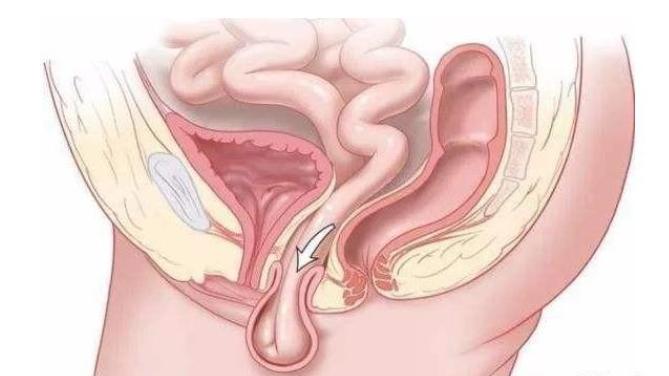 濂冲瓙渚跨瀵艰嚧瀛愬鑴卞瀭,鏀惧眮瀵艰嚧瀛愬鑴卞瀭
