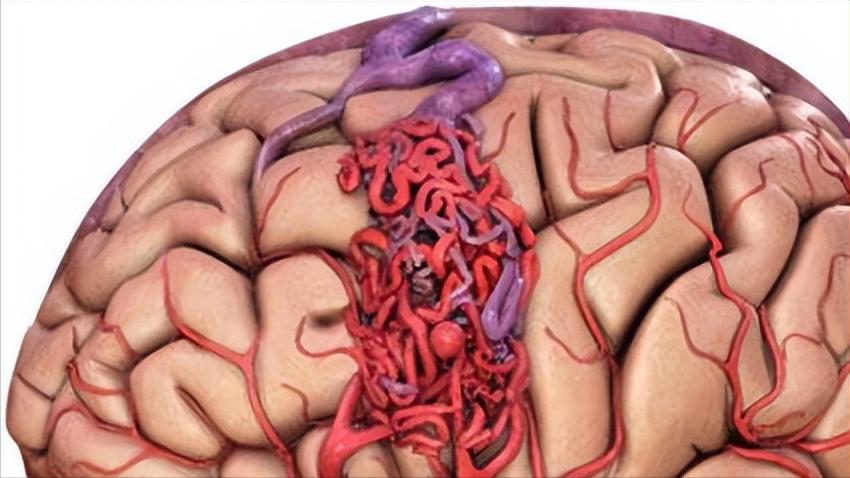 高血压引起脑出血最佳抢救时间,家里老人有点脑出血一般怎么治