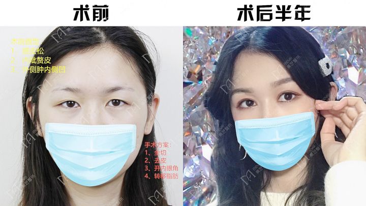 割双眼皮是属于整形还是美容,割双眼皮就是整容吗