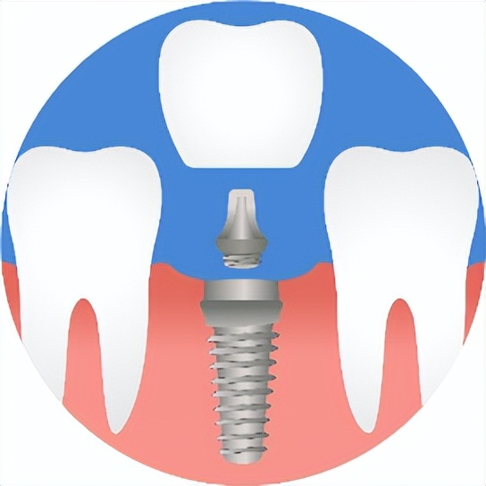 二手翻新植体,二手翻新种植体