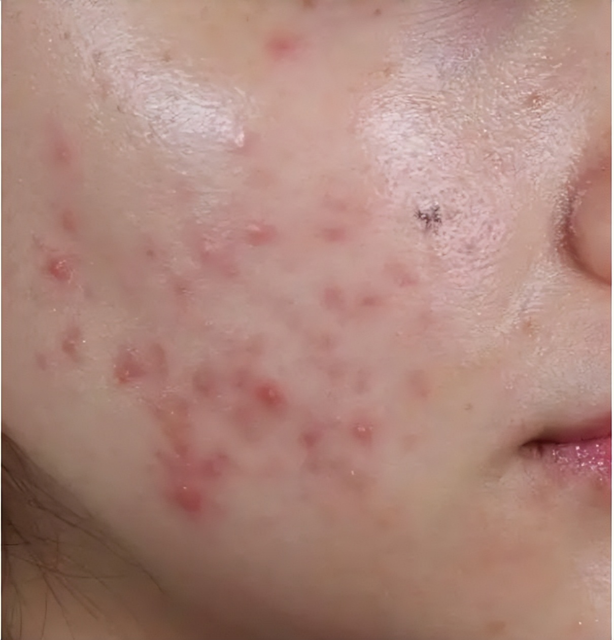 痘痘怎么护理和消除,痘痘怎么自然养好