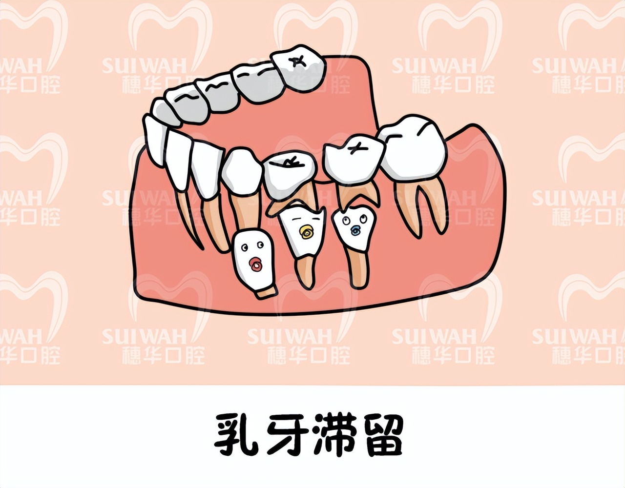 北大口腔医院儿童牙齿不齐矫正,儿童牙齿矫正北京大学口腔医院