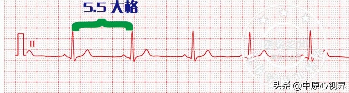 护考几种常见的心电图,常见的心电图图形分析
