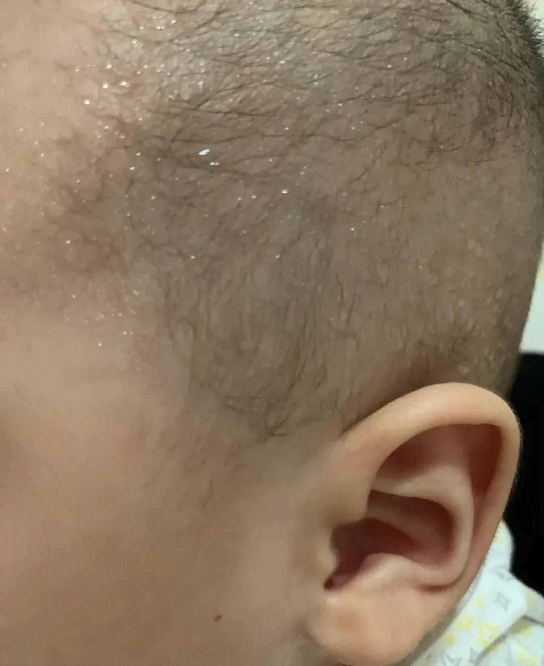 孩子汗多什么原因中医,孩子汗多挑食是什么原因