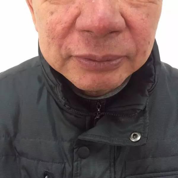 家庭祛除螨虫的有效方法是什么,家里有螨虫用什么东西除螨好