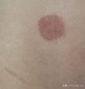 92名儿童被三伏贴灼伤看着心疼,小孩贴三伏贴被烧了