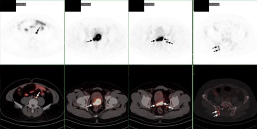 psma治疗前列腺癌,psma放射配体疗法