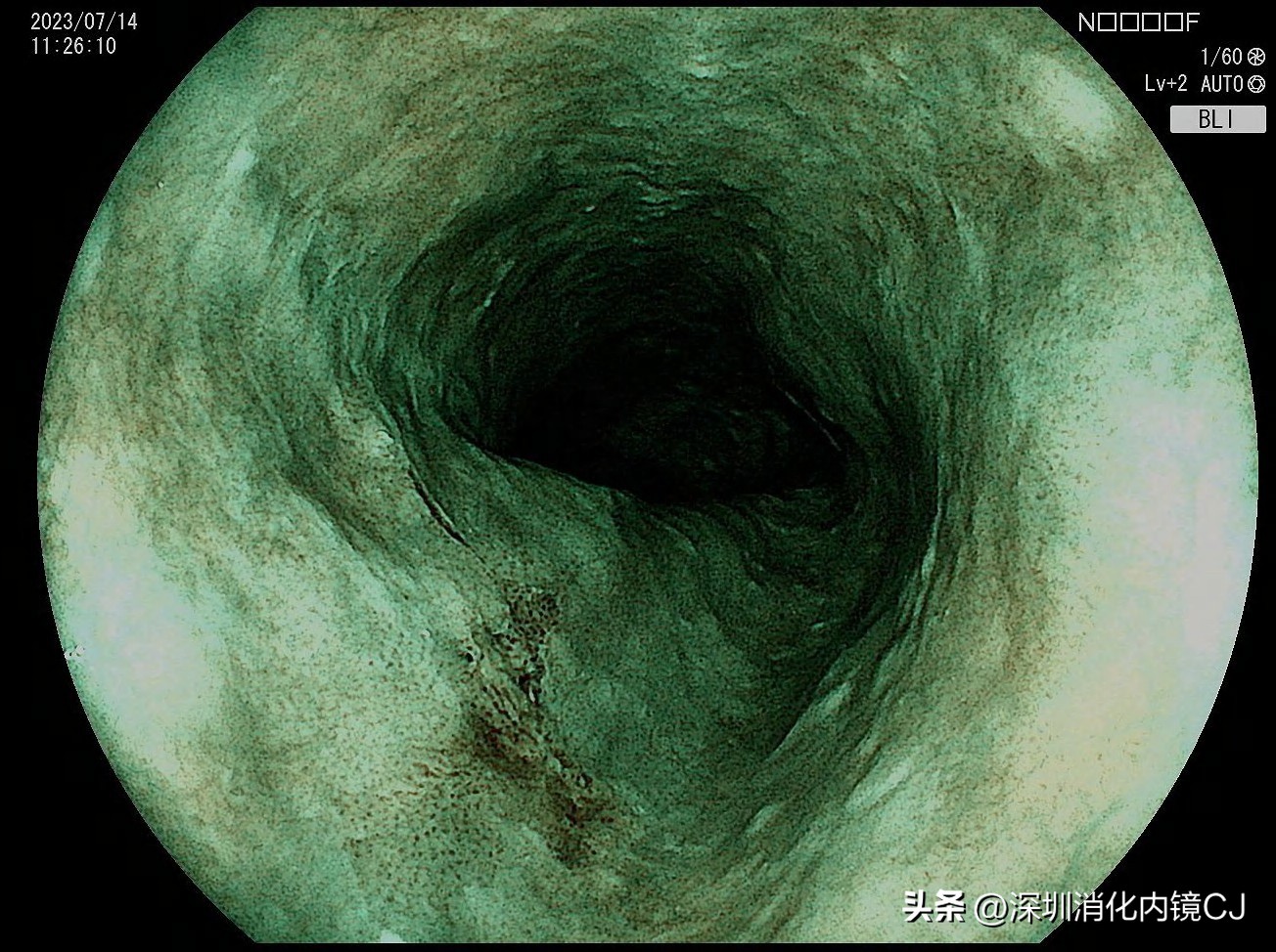 69岁及时发现食管癌，内镜下微创根治，避免了外科开胸手术