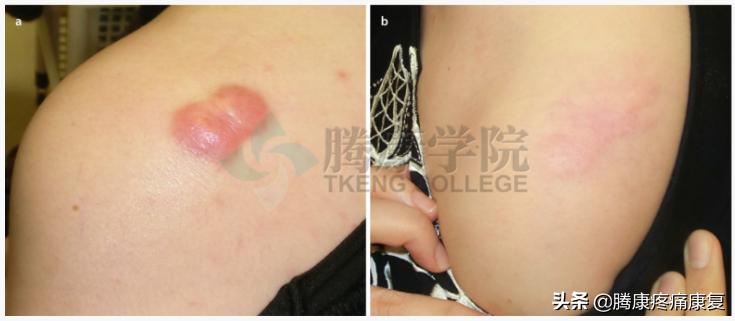 增生性瘢痕和瘢痕疙瘩的鉴别诊断,皮质类固醇贴