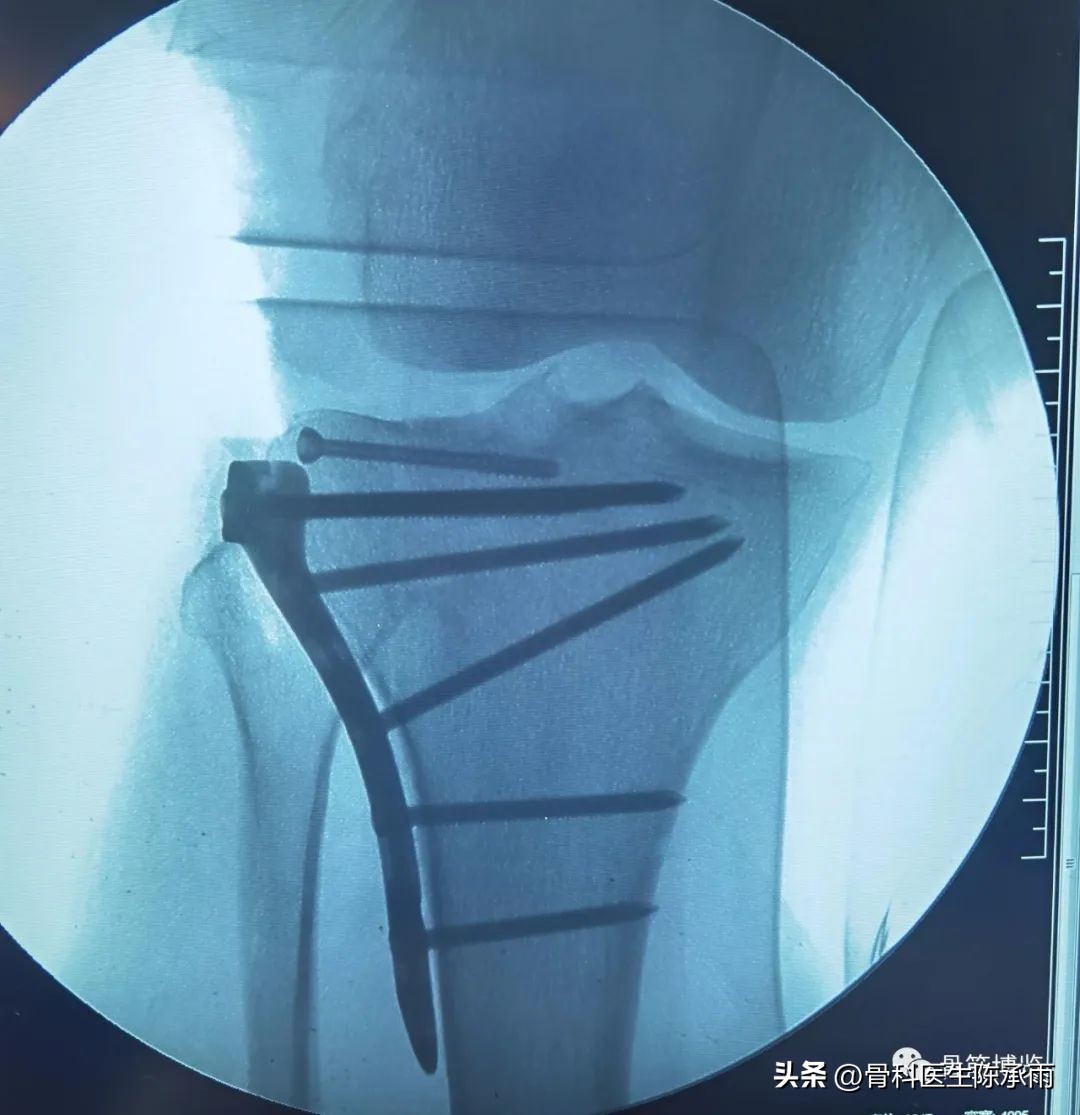 膝关节胫骨平台骨折,最近胫骨平台骨折视频