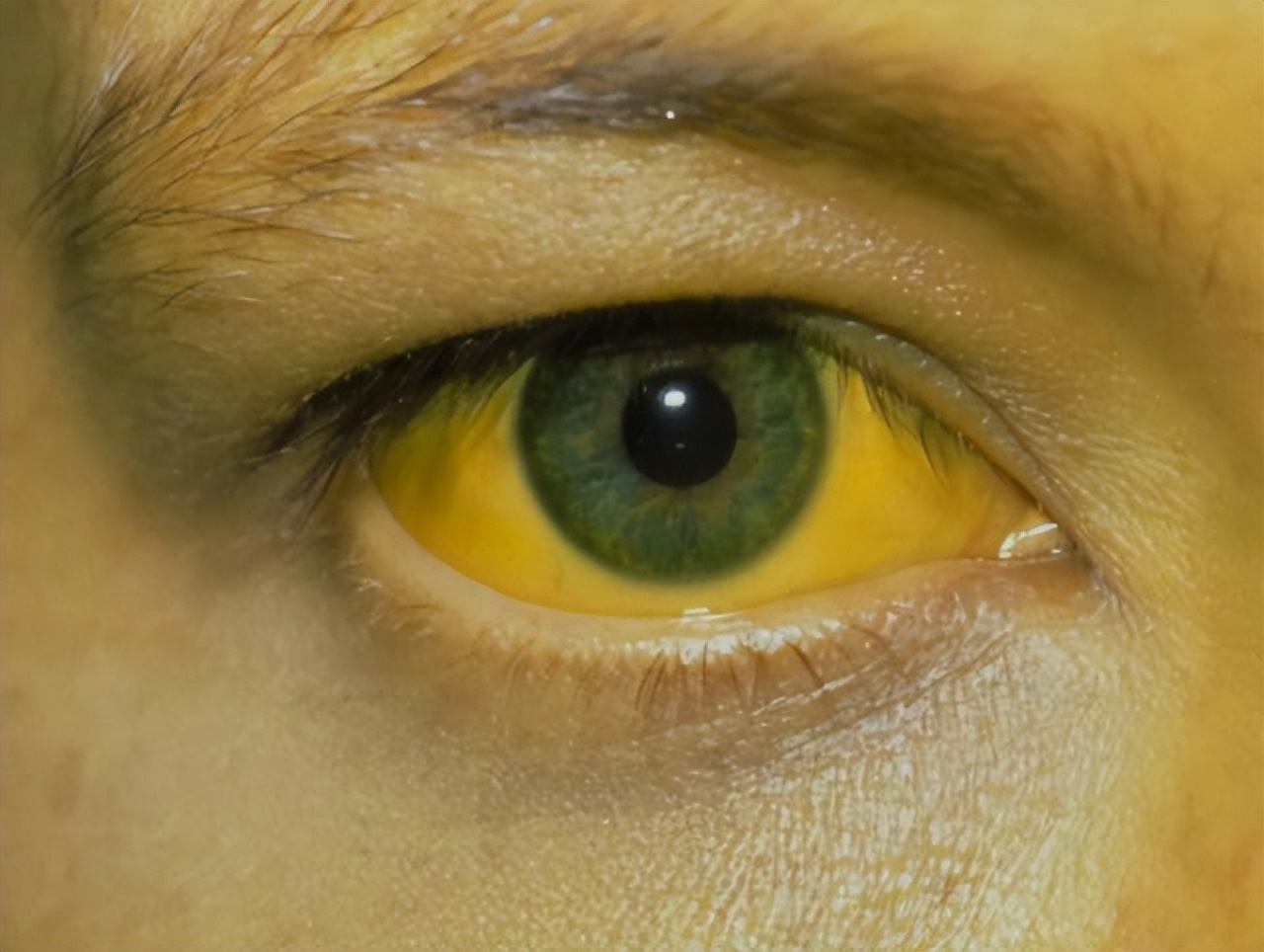 胰腺癌晚期胆管堵塞的症状及表现,胰腺癌晚期回光返照是什么症状