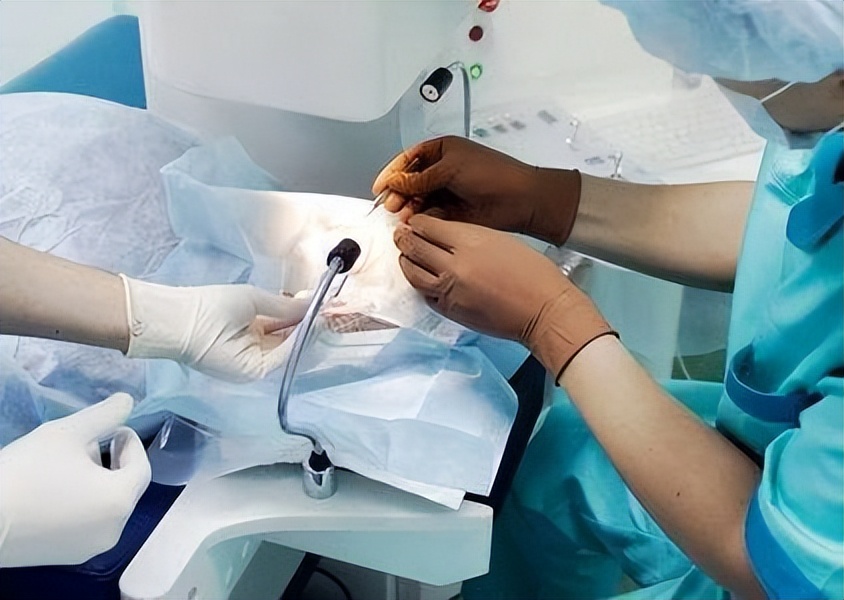 激光手术治近视眼有啥后遗症,大部分人都可以激光手术治近视眼