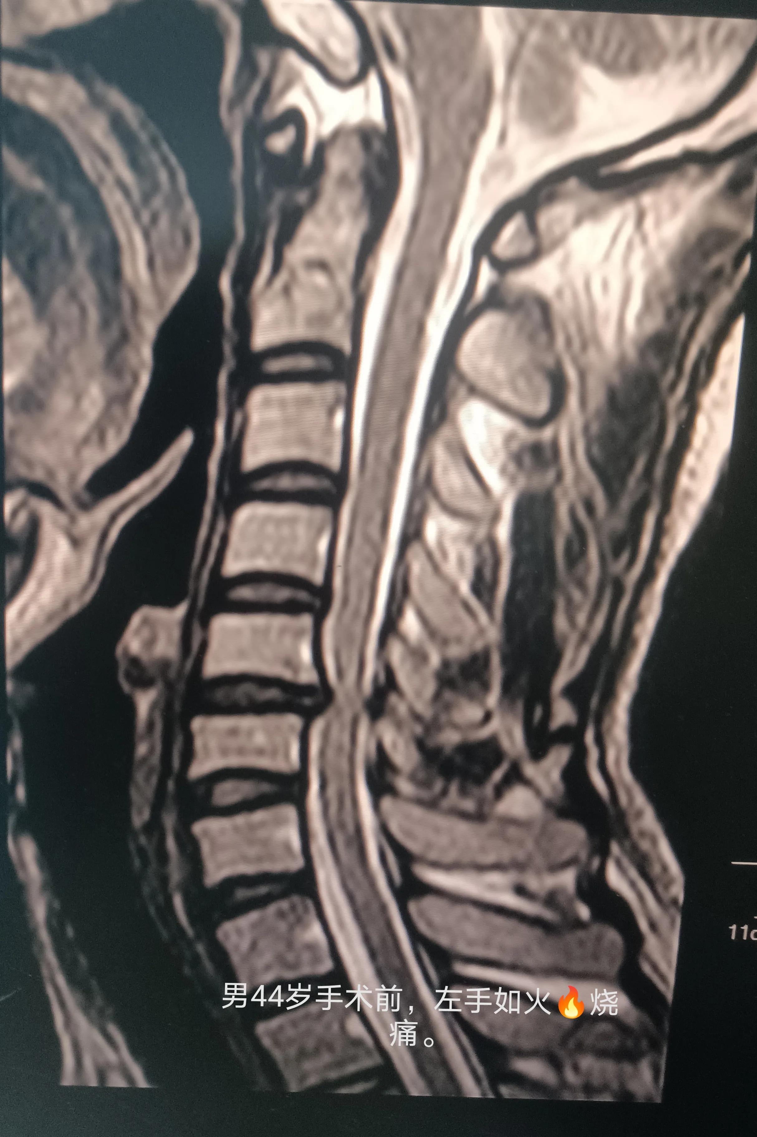 中医颈椎病的诊疗方案及临床效果,颈椎病中医适宜技术