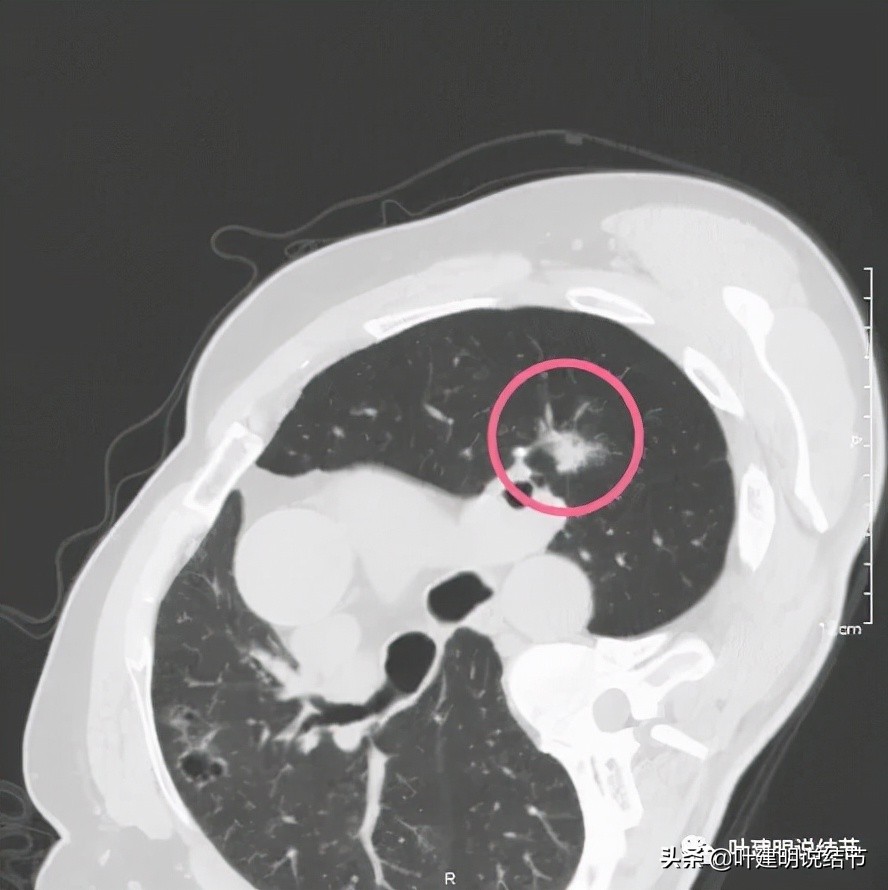 肺多发结节切除一个剩下的怎么办,无限纠结的肺小结节
