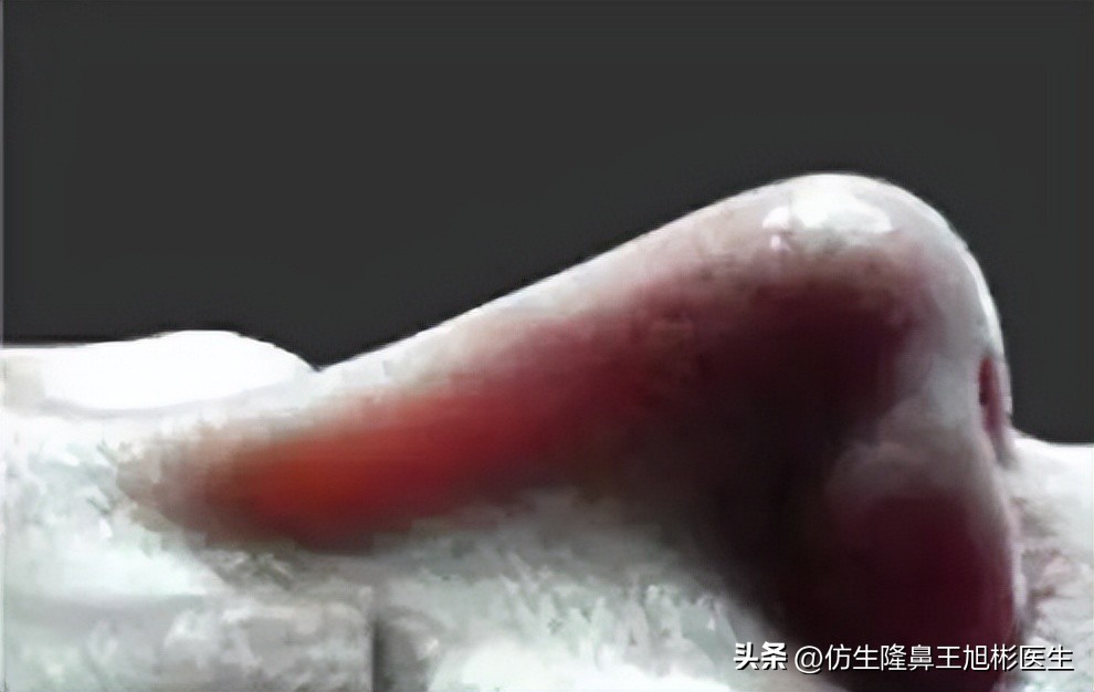 假体隆鼻和自体隆鼻的区别,隆鼻是假体好还是膨体好