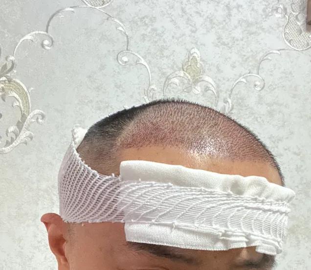 花费四万元植发一年后效果仍不明,男生大面积植发八个月真实效果