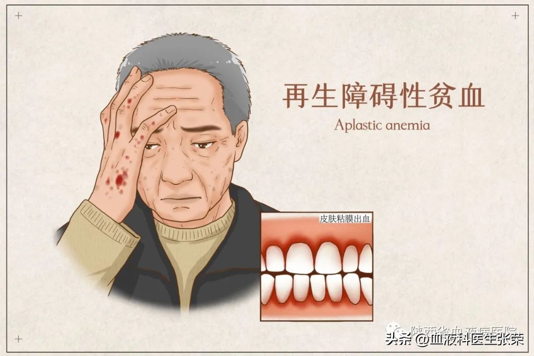 再障贫血需要做什么检查,血液病医生说再障啥意思