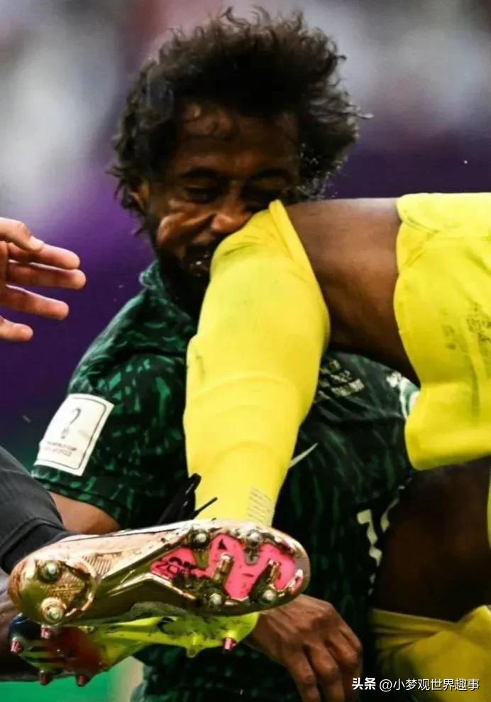 沙赫拉尼鼻骨骨折,沙赫拉尼头骨骨折x光