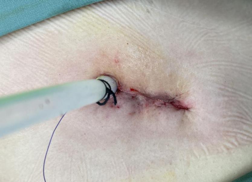 深呼吸右边肺漏气,感觉肺部漏气的感觉