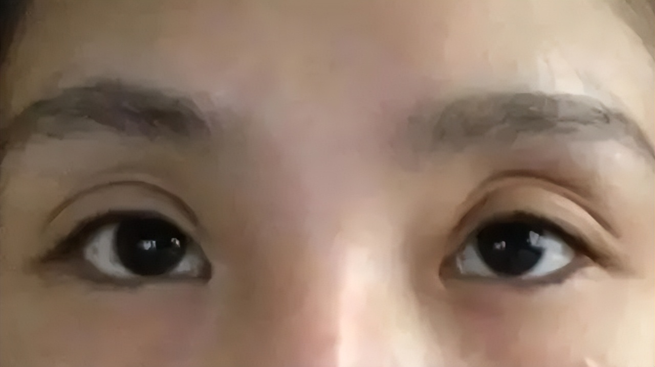 眼窝凹陷自我矫正训练,眼窝凹陷眼珠凸出训练