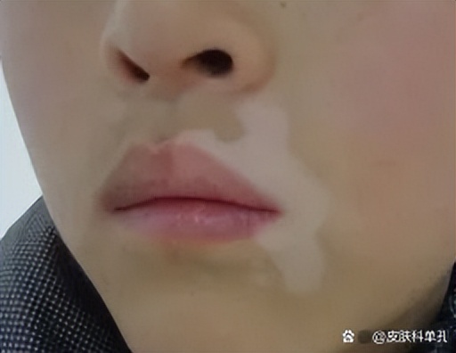 白斑发红发痒是什么原因,白斑痒了是意味着白斑发展了吗