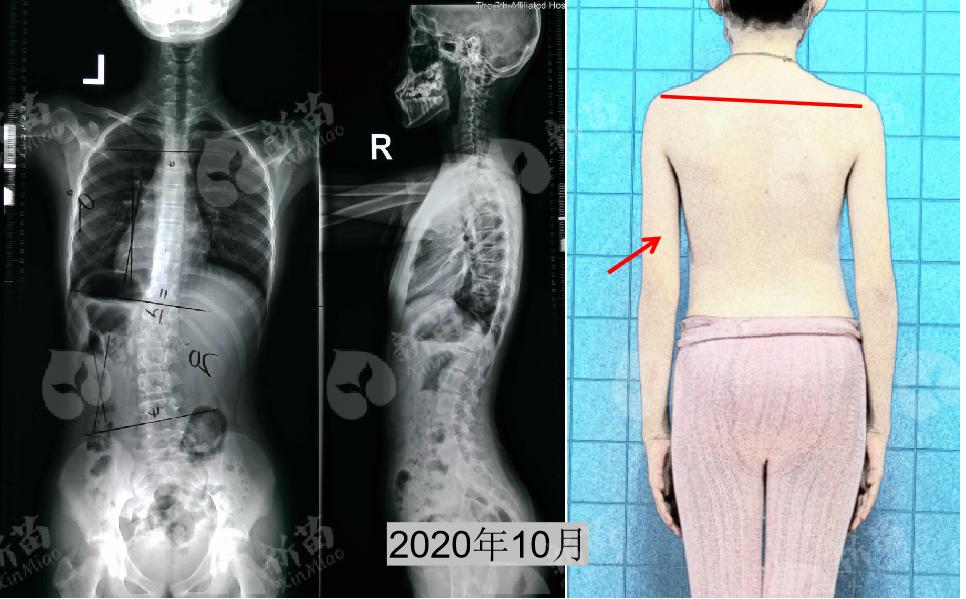 12岁女孩矫正脊柱侧弯,女孩侧弯矫正锻炼