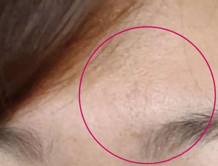 第一次打水光针爆痘,第一次打水光针反黑了