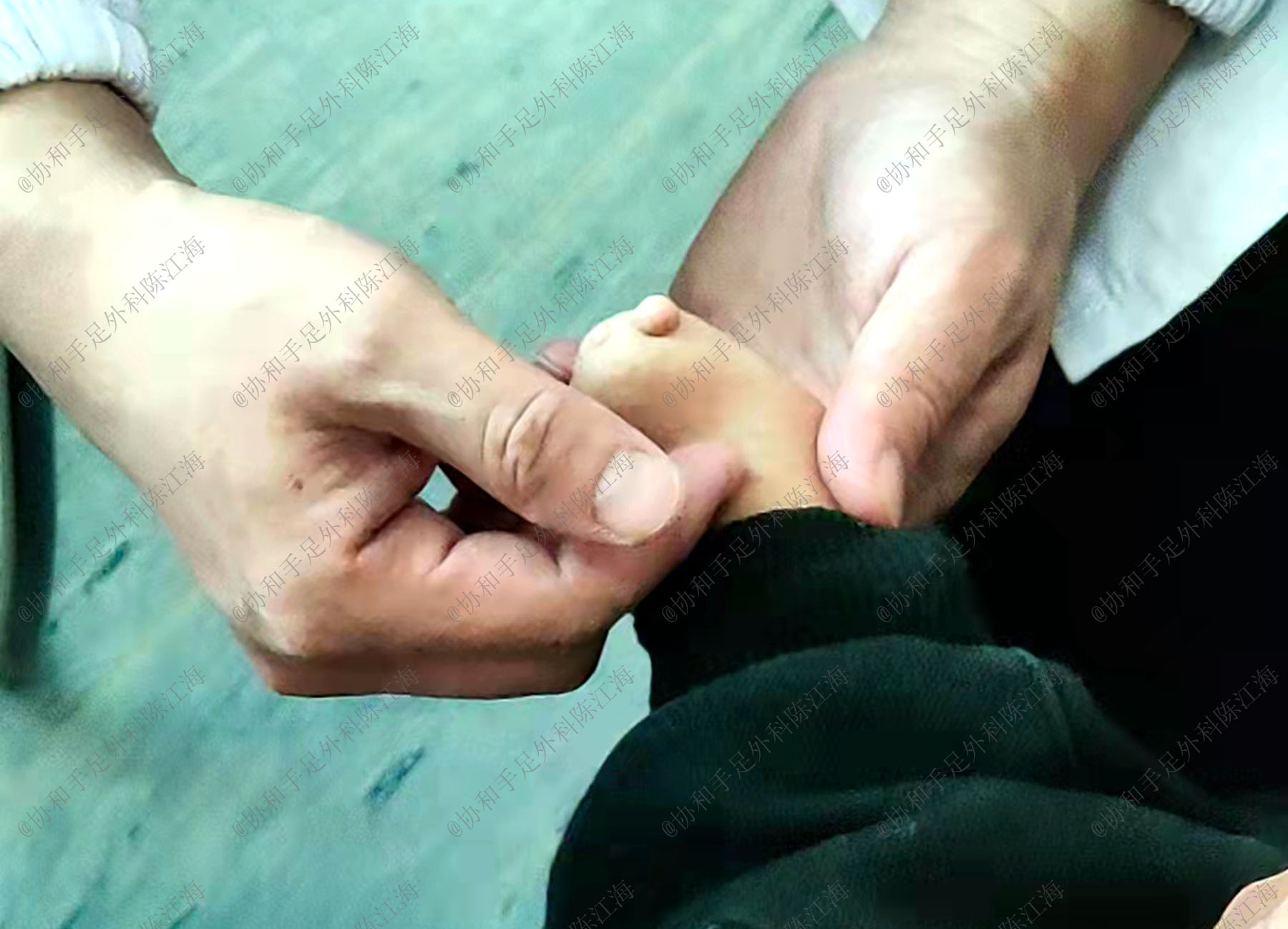 孩子出生手脚畸形怎么办,手足畸形可以治疗吗