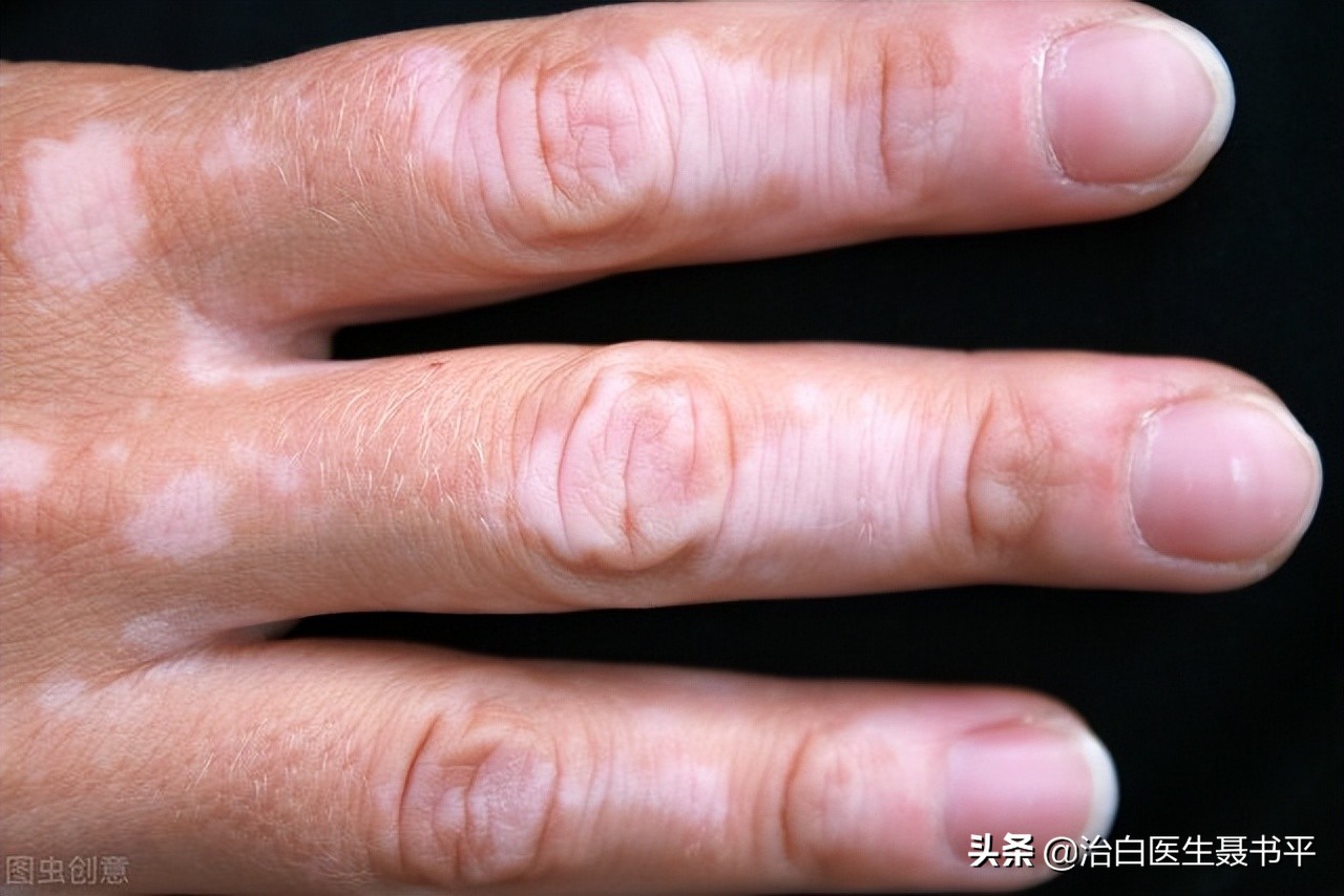 刚出现的白癜风照308激光治疗，一般多久能有效果？