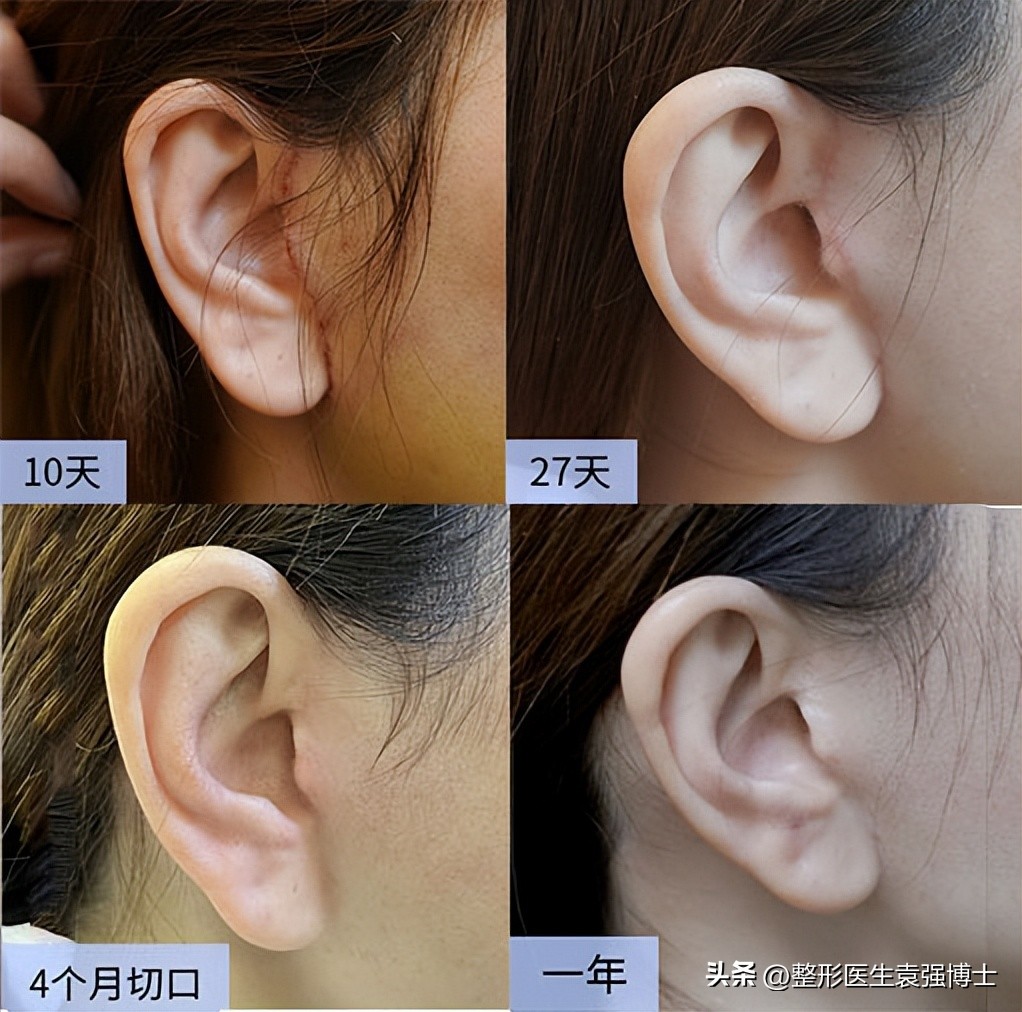 拉皮手术疤痕夸张,耳后切口拉皮疤痕图片