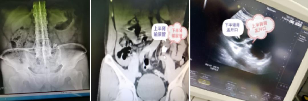 二院泌尿外科手术,平南县医院泌尿外科