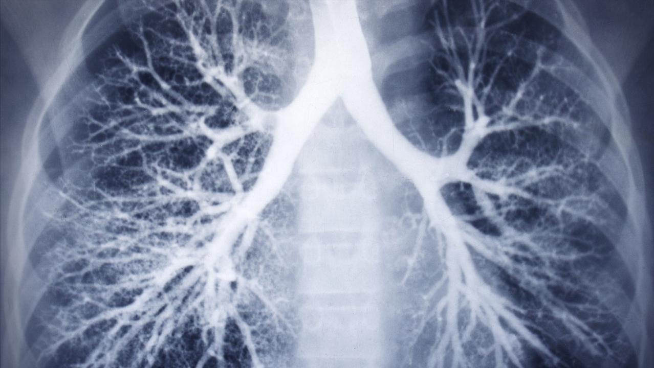 肺纹理增多可能是什么病,肺纹理增多主要是哪种病引起的