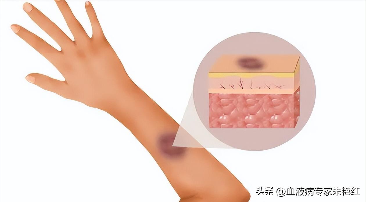 血小板减少症的干性出血和湿性出血指的是什么？