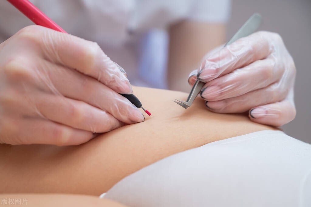 “下面”的毛有什么用,能剔除吗?医生:有2种情况,剔除更好