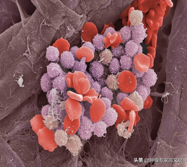 肿瘤肺转移和骨转移哪个严重,肿瘤肺转移症状