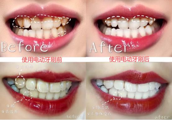 儿童电动牙刷的好处和危害,电动牙刷的危害弊端