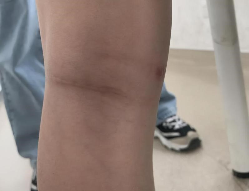 腿弯长了个包？小心是腘窝囊肿