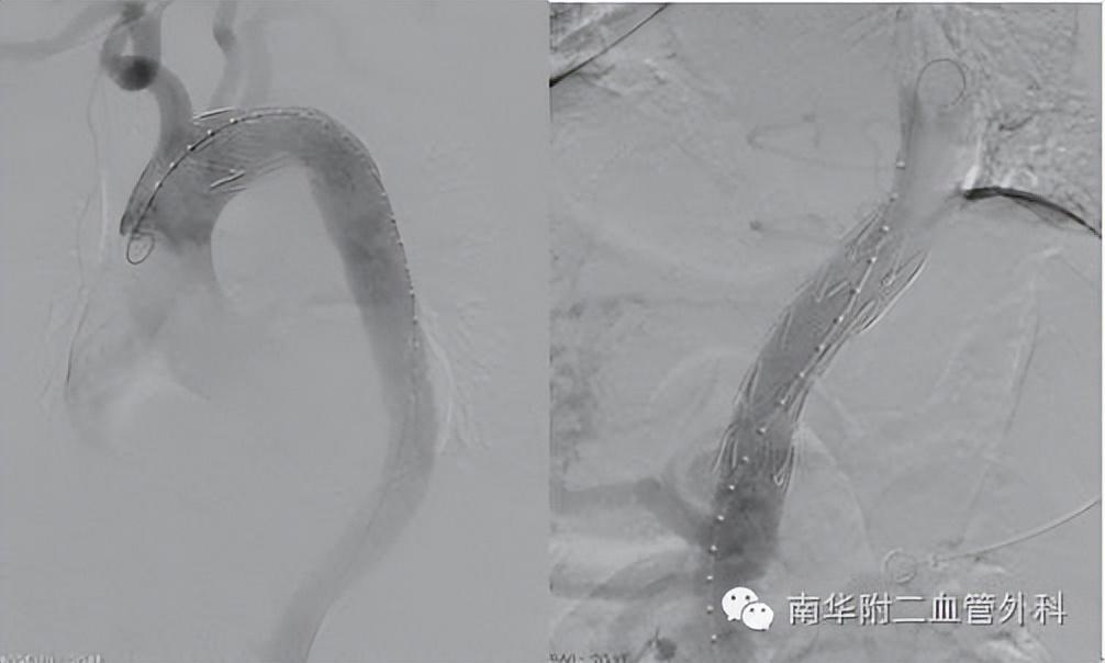 心脏主动脉溃疡,主动脉多发穿透性溃疡