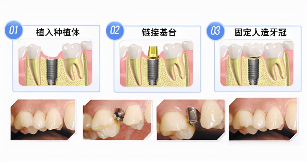 种植牙真的好吗,种植牙的优缺点一次说全建议收藏