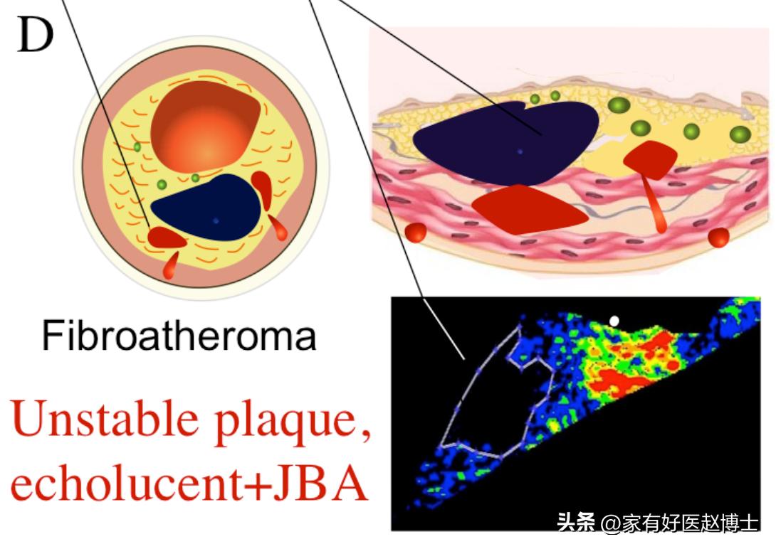 超声颈动脉可以查出什么原因,超声颈动脉斑块的危险评估