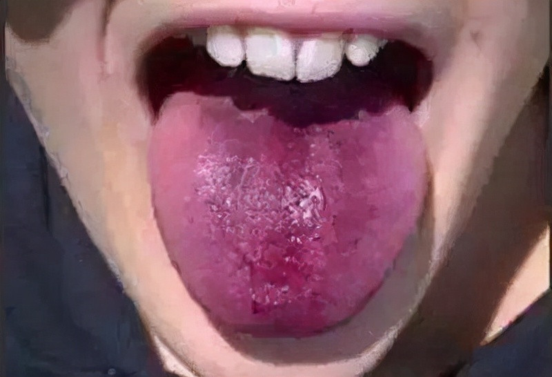 舌头两侧瘀血紫暗是怎么回事,舌头紫暗吃什么调理