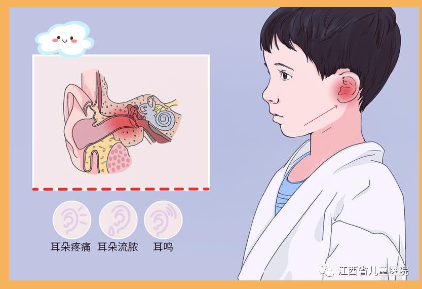 急性中耳炎耳朵疼怎么快速止痛,4岁儿童急性中耳炎耳朵发红