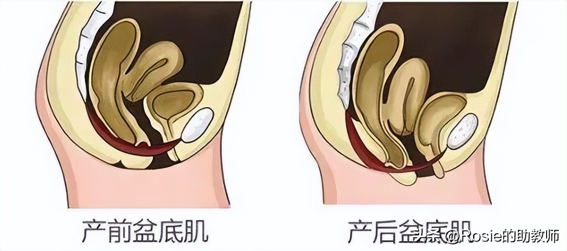 张歆艺产后盆底肌视频,张歆艺产后恢复过程