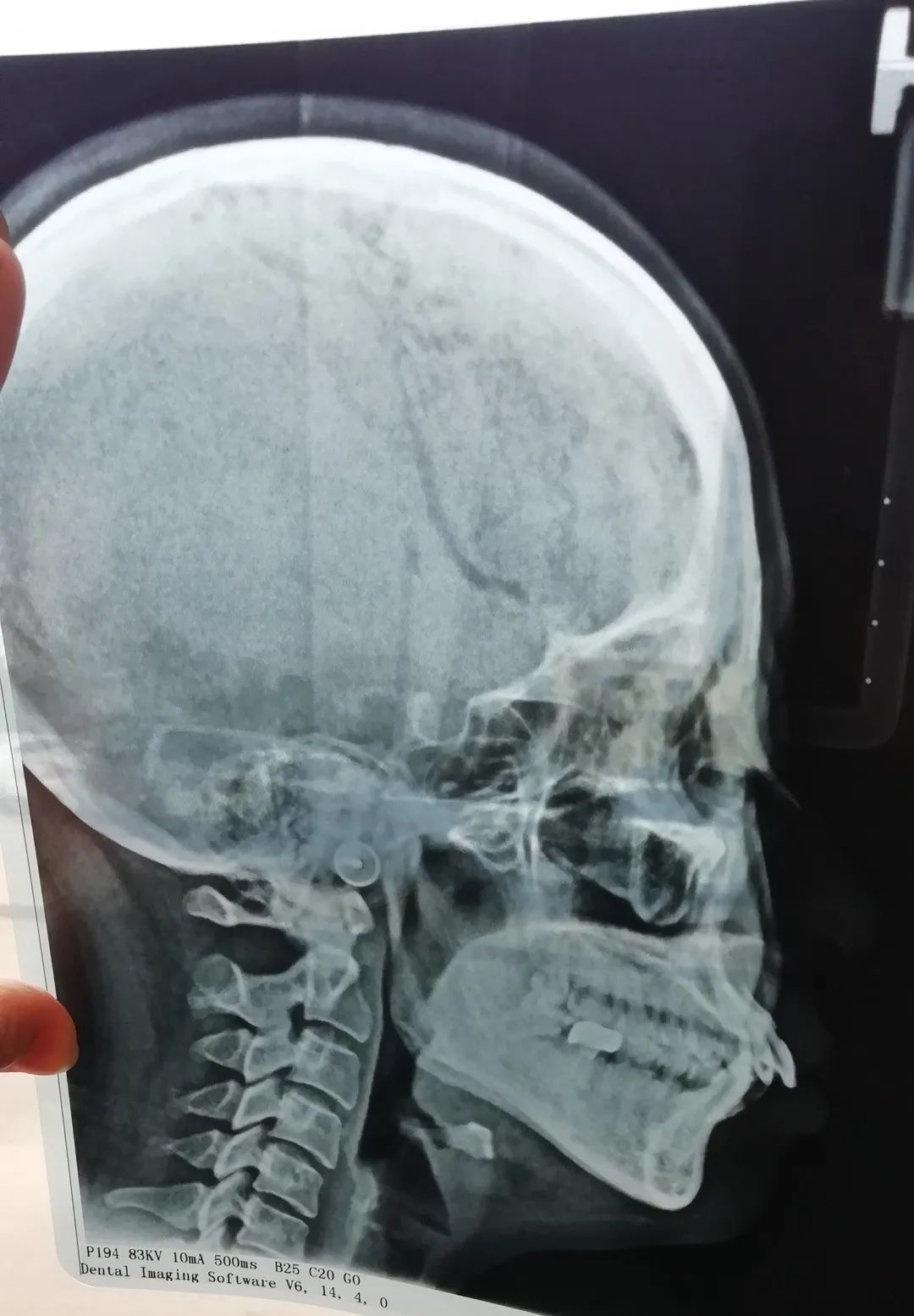 整牙亲身经历经验分享,整牙的经验分享