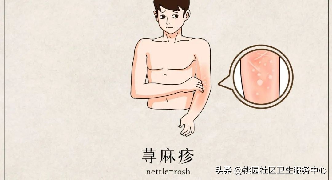 引发荨麻疹的各种原因,麻疹病毒肺炎的病因是什么