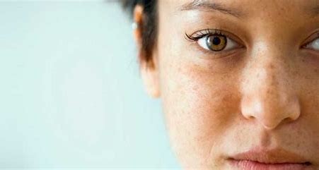 怎么预防老年人长老年斑,老年为什么要长老年斑