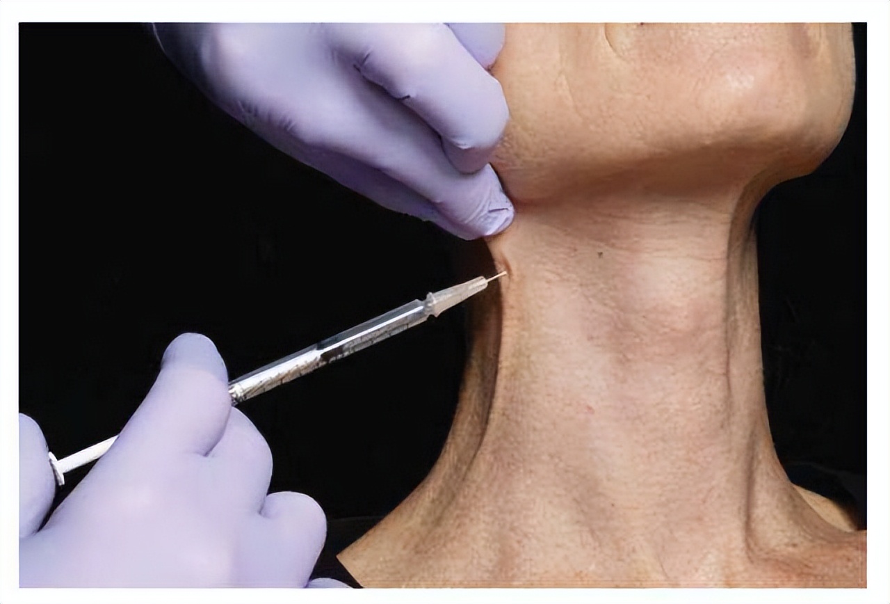 颈纹很显老手把手教你小妙招,颈纹深怎么减淡