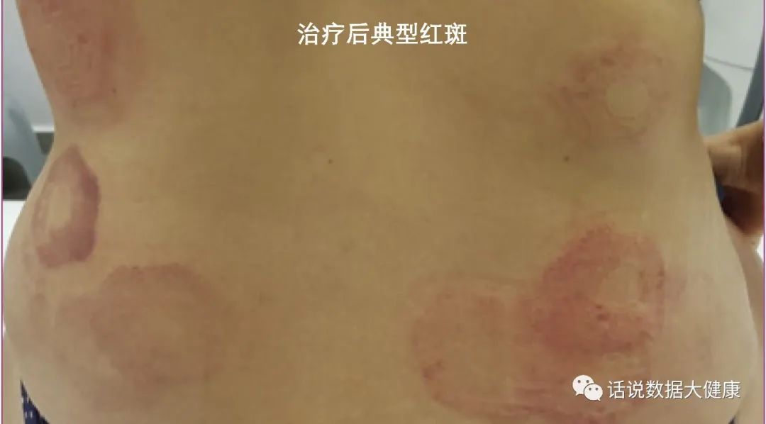 超声减脂注意事项,激光减脂和射频减脂的区别