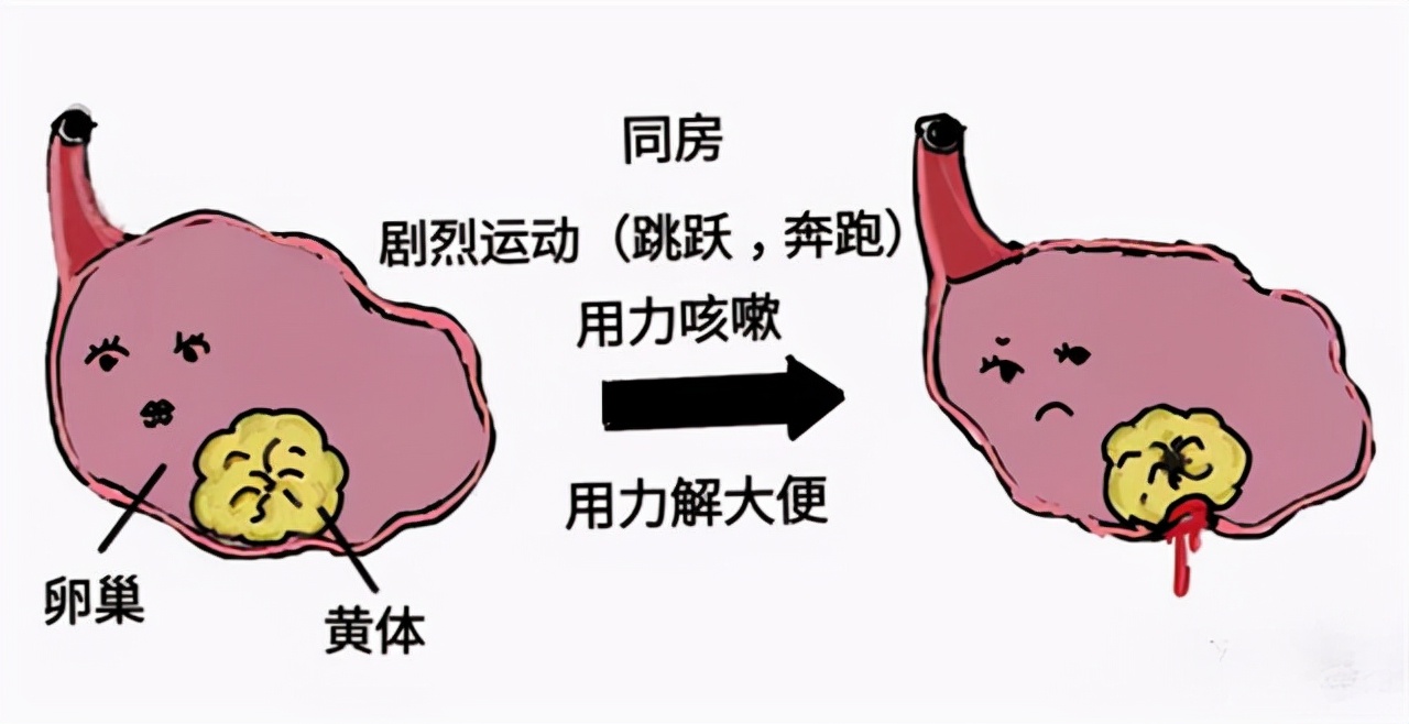 憋尿黄体破裂是怎么回事,运动可能导致黄体破裂吗